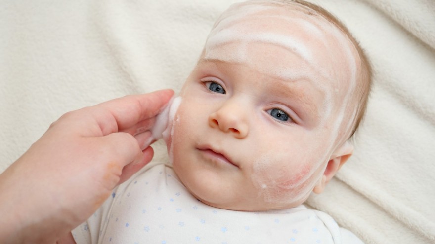 Zwalczanie trądziku niemowlęcego - skuteczne metody i środki podczas leczenia